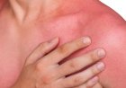 Remedii naturale pentru arsuri solare