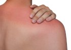 Remedii rapide și naturale contra arsurilor solare