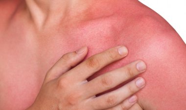 Remedii naturale pentru arsuri solare