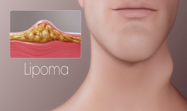 Ce este lipomul