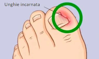Unghia încarnată, cauze și tratament