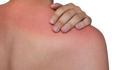 Remedii rapide și naturale contra arsurilor solare