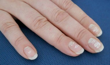 Revista scrisorilor de frumusețe. „De ce am pete albe pe unghii?”