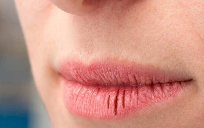 Cum se tratează buzele crăpate în mod natural?